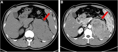 Non-islet cell tumor hypoglycemia concurrent with acromegalic features: A case report and literature review
